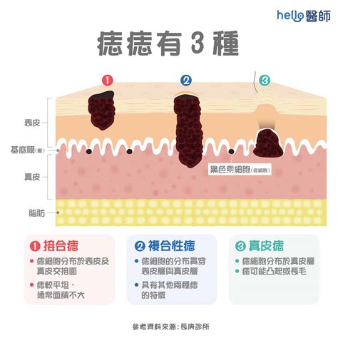 為什麼身上會有痣|為什麼臉上的痣越來越多？皮膚科醫師解析長痣原因、。